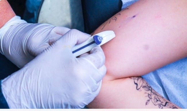 Paraíba vai ofertar contraceptivo subdérmico e capacita médicos e enfermeiros da Atenção Básica